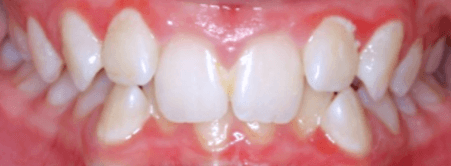 After treatment
